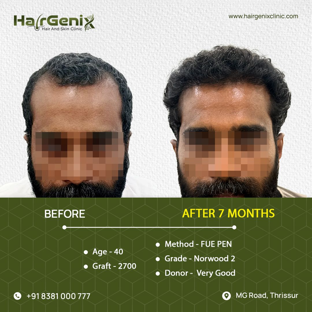 Hair Transplant Treatment 1