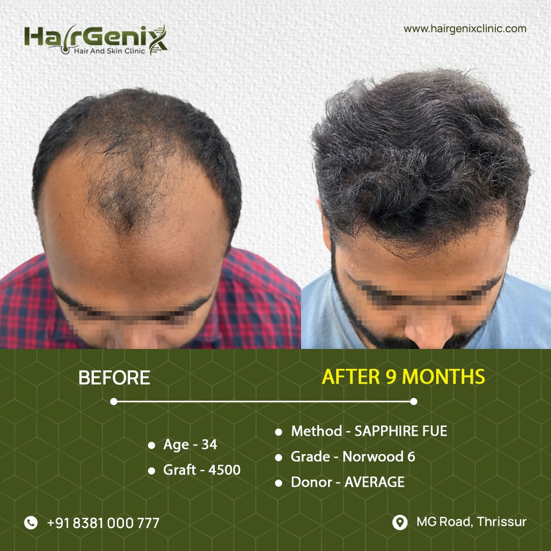 Hair Transplant Treatment 2