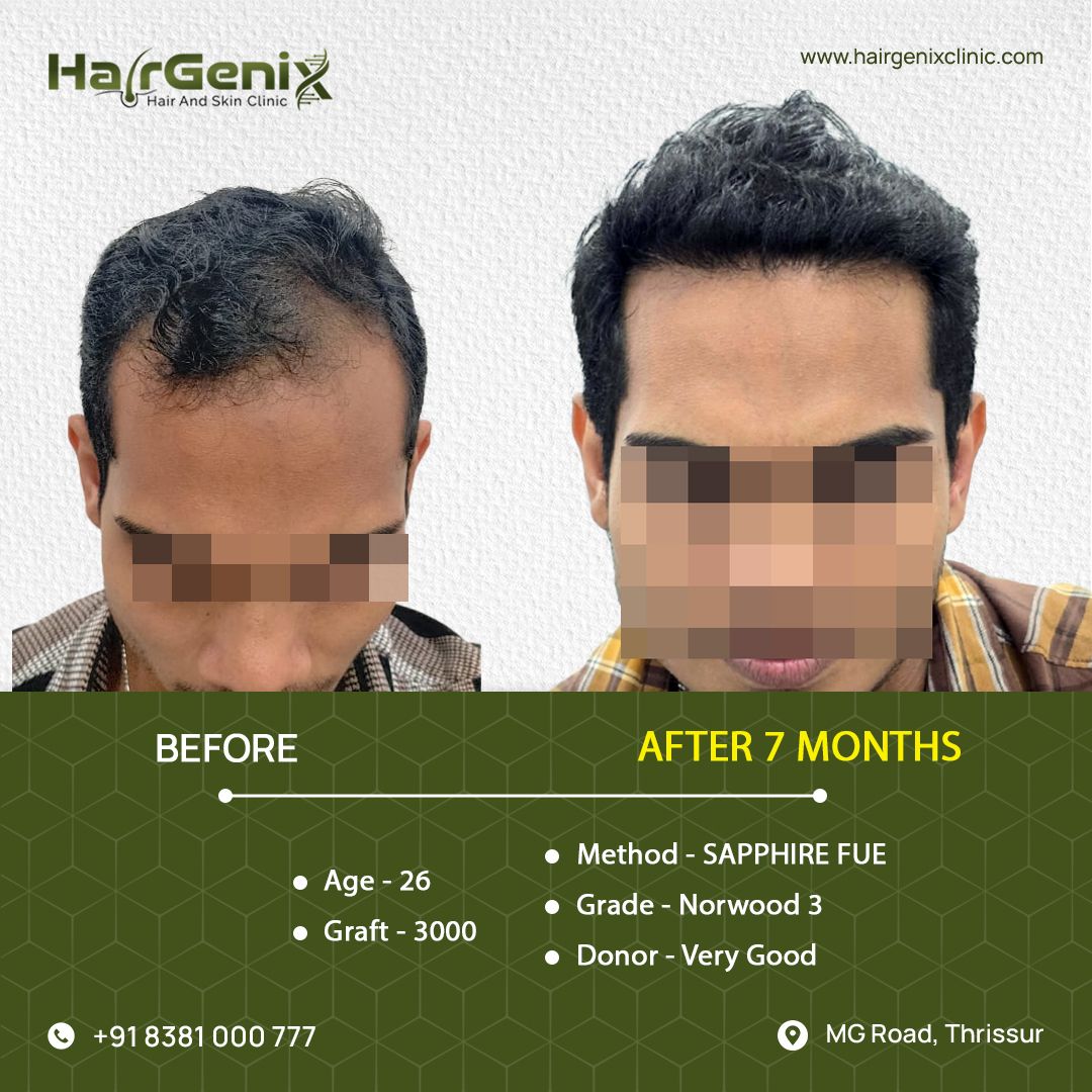 Hair Transplant Treatment 5
