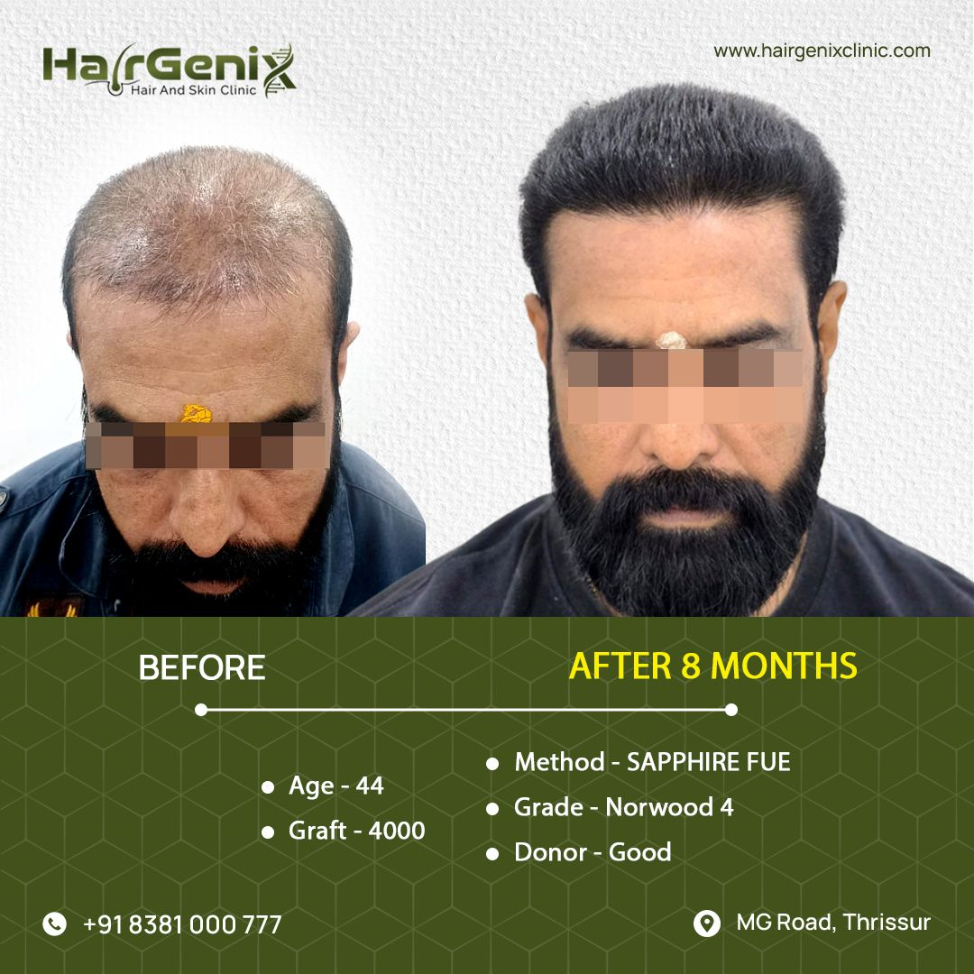 Hair Transplant Treatment 6