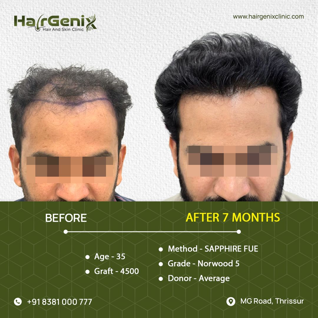 Hair Transplant Treatment 7