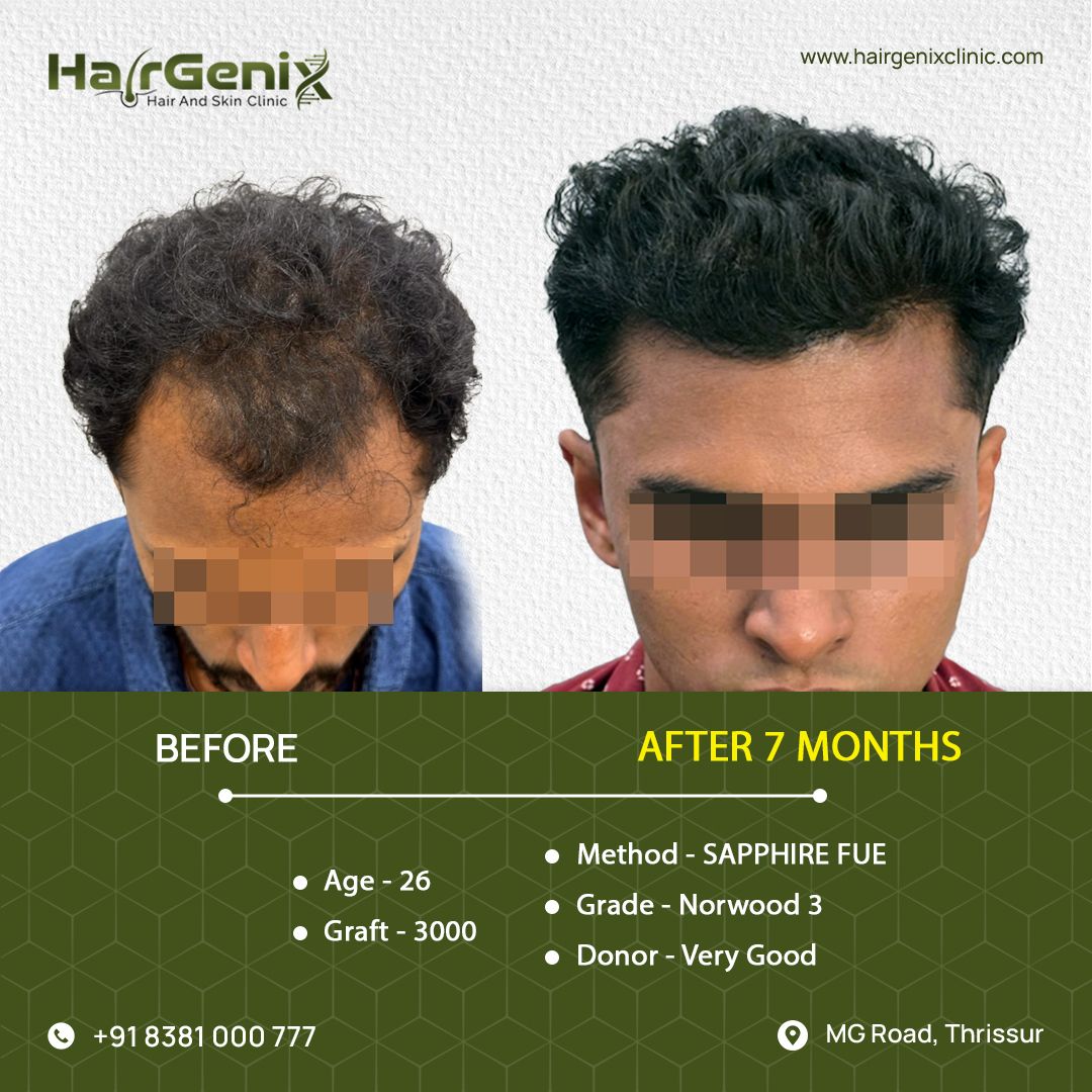 Hair Transplant Treatment 8