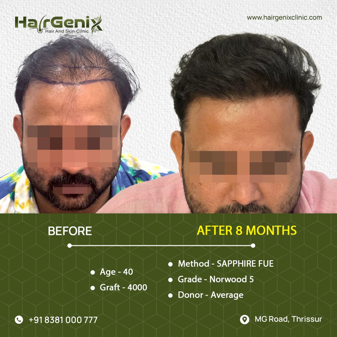 Hair Transplant Treatment 9