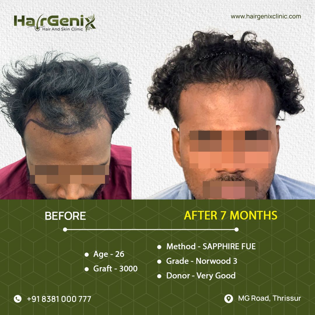Hair Transplant Treatment 10