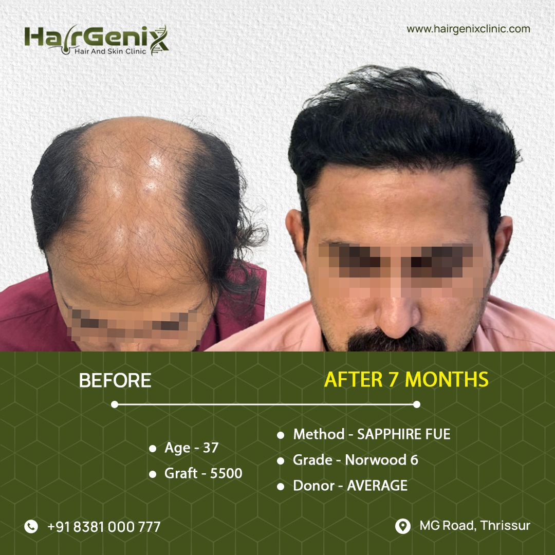 Hair Transplant Treatment 11