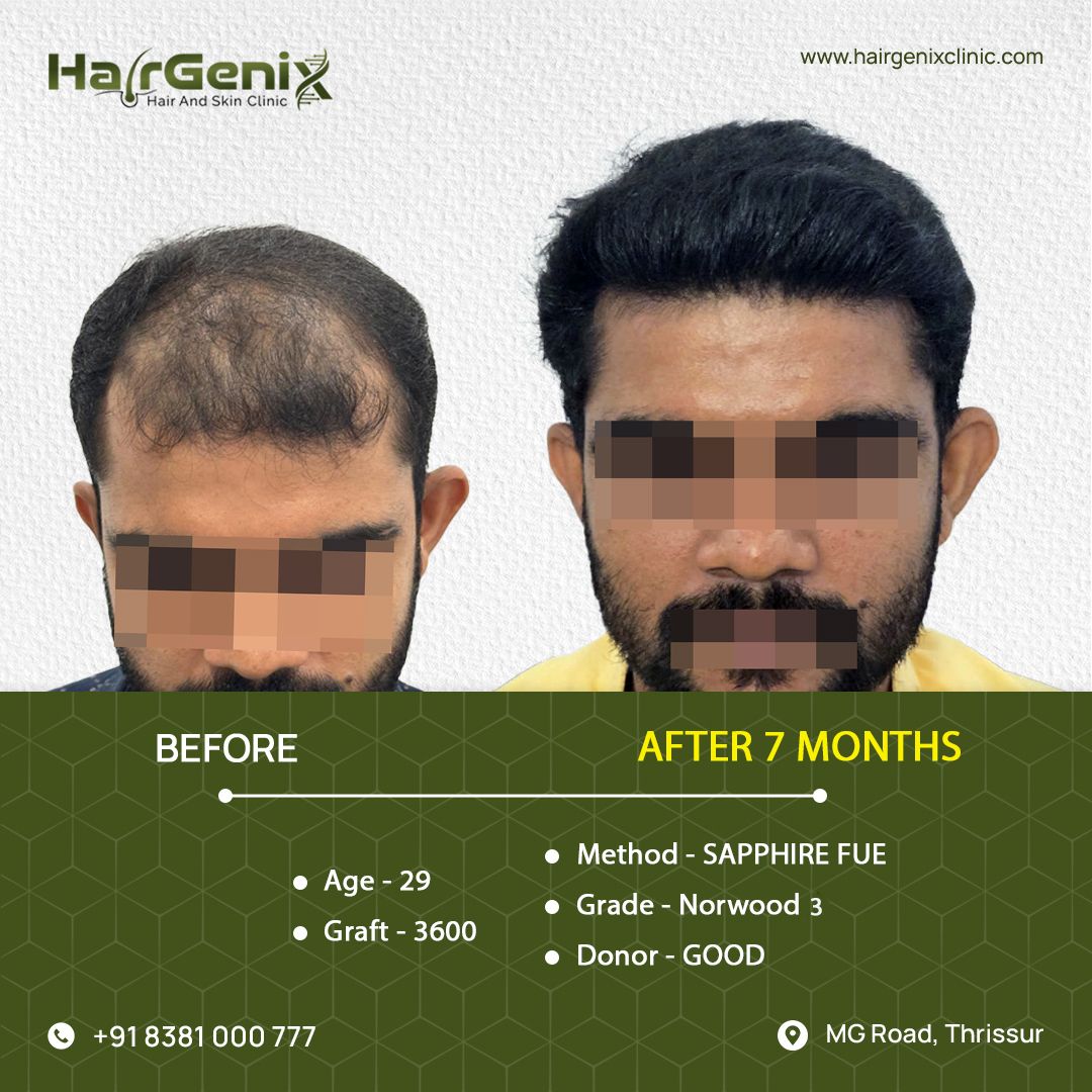 Hair Transplant Treatment 12