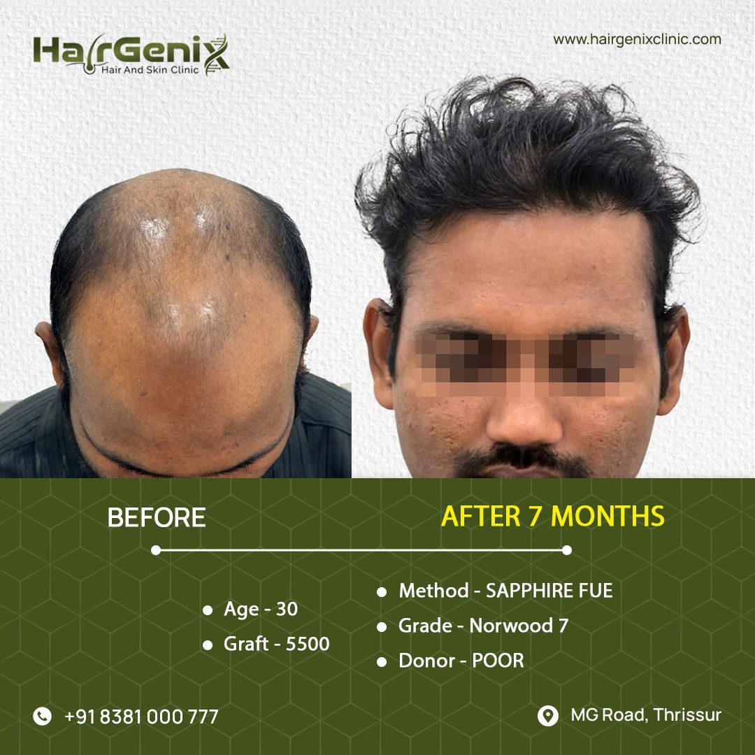 Hair Transplant Treatment 13