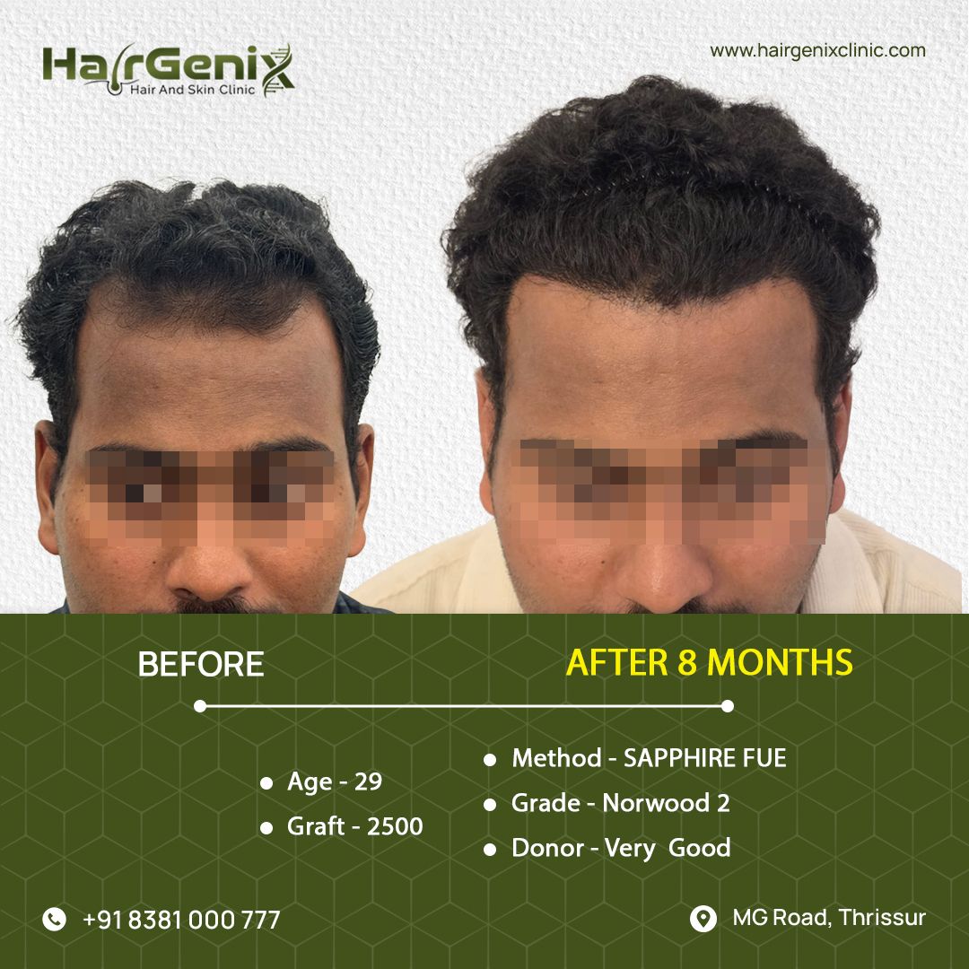 Hair Transplant Treatment 14